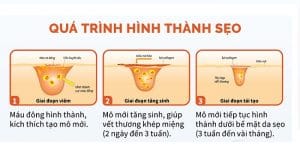 Điều trị các loại sẹo uy tín Hải Phòng tại Thẩm Mỹ Mộc Linh - hình 44