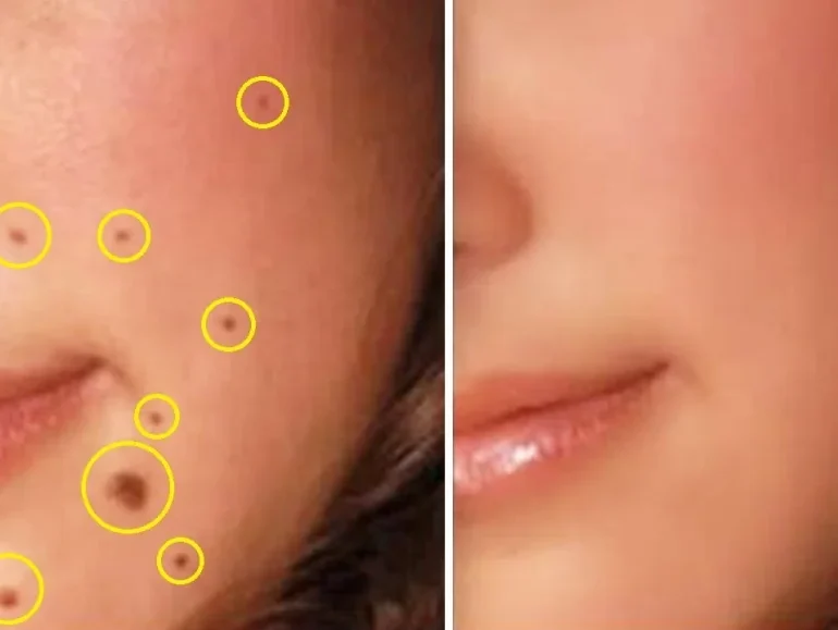Tẩy nốt ruồi bằng laser có để lại sẹo không tại Hải Phòng