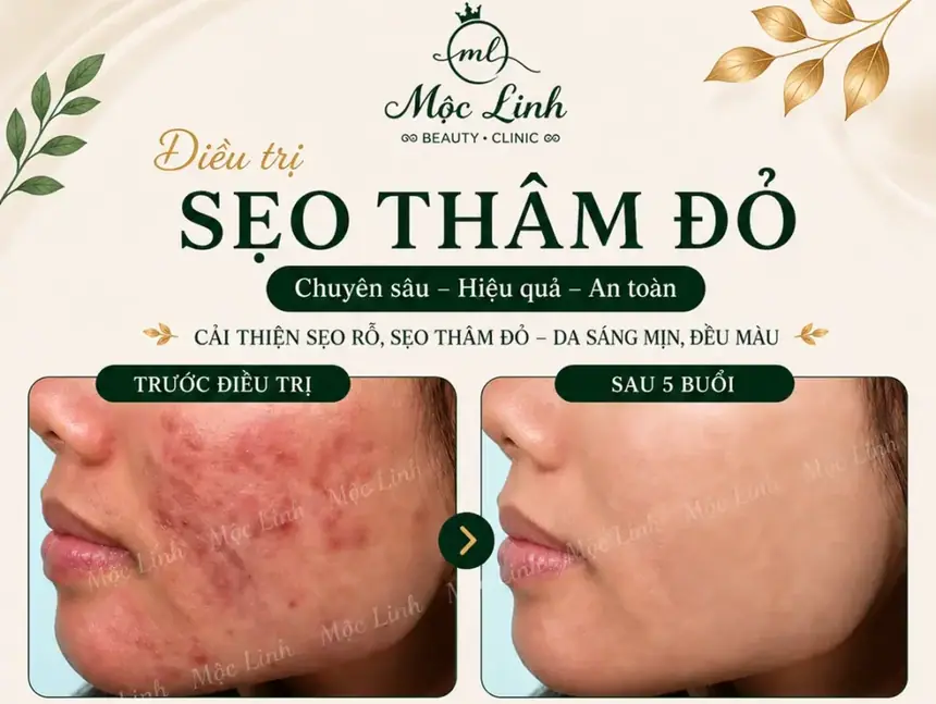 Điều trị các loại sẹo uy tín Hải Phòng tại Thẩm Mỹ Mộc Linh - hình 8