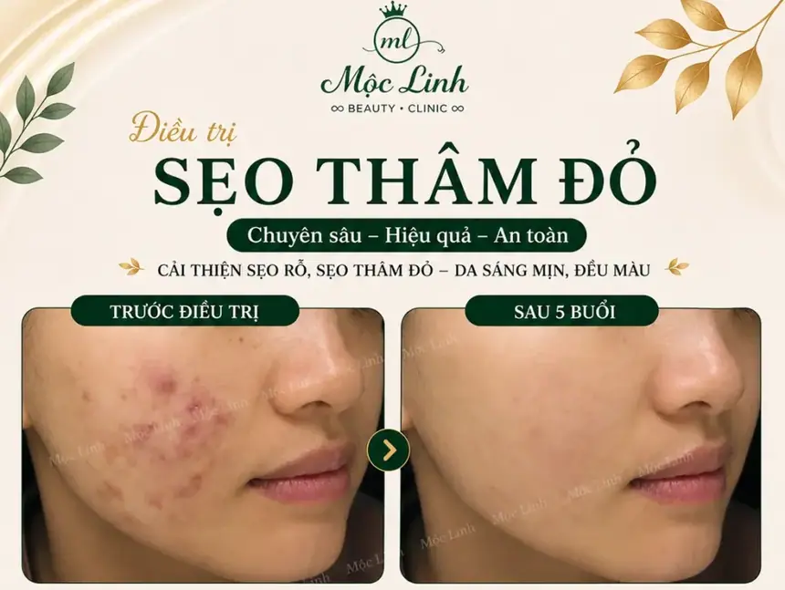 Điều trị các loại sẹo uy tín Hải Phòng tại Thẩm Mỹ Mộc Linh - hình 6