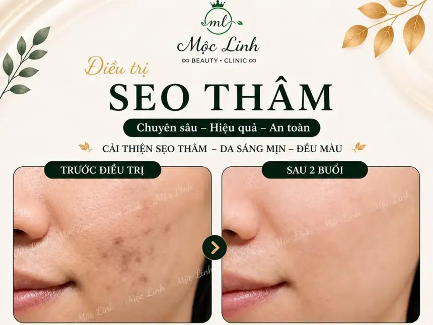 Điều trị các loại sẹo uy tín Hải Phòng tại Thẩm Mỹ Mộc Linh - hình 4
