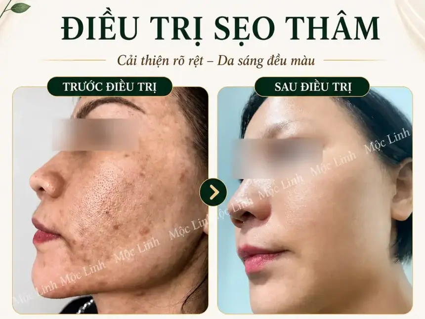 Điều trị các loại sẹo uy tín Hải Phòng tại Thẩm Mỹ Mộc Linh - hình 2
