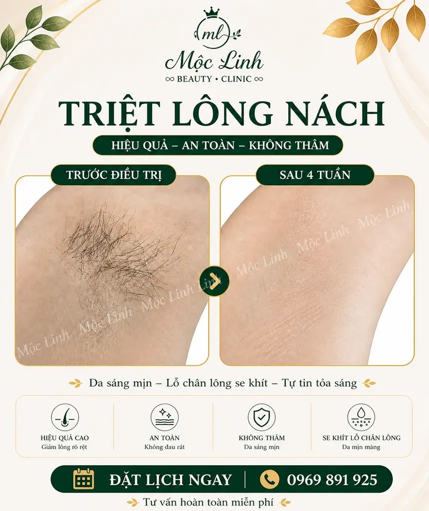 Triệt lông nách hiệu quả tại Thẩm Mỹ Mộc Linh Hải Phòng