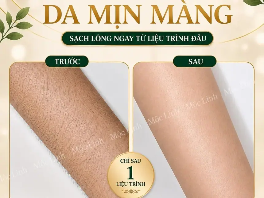 Triệt Lông Hải Phòng tại Thẩm Mỹ Mộc Linh - hình 5
