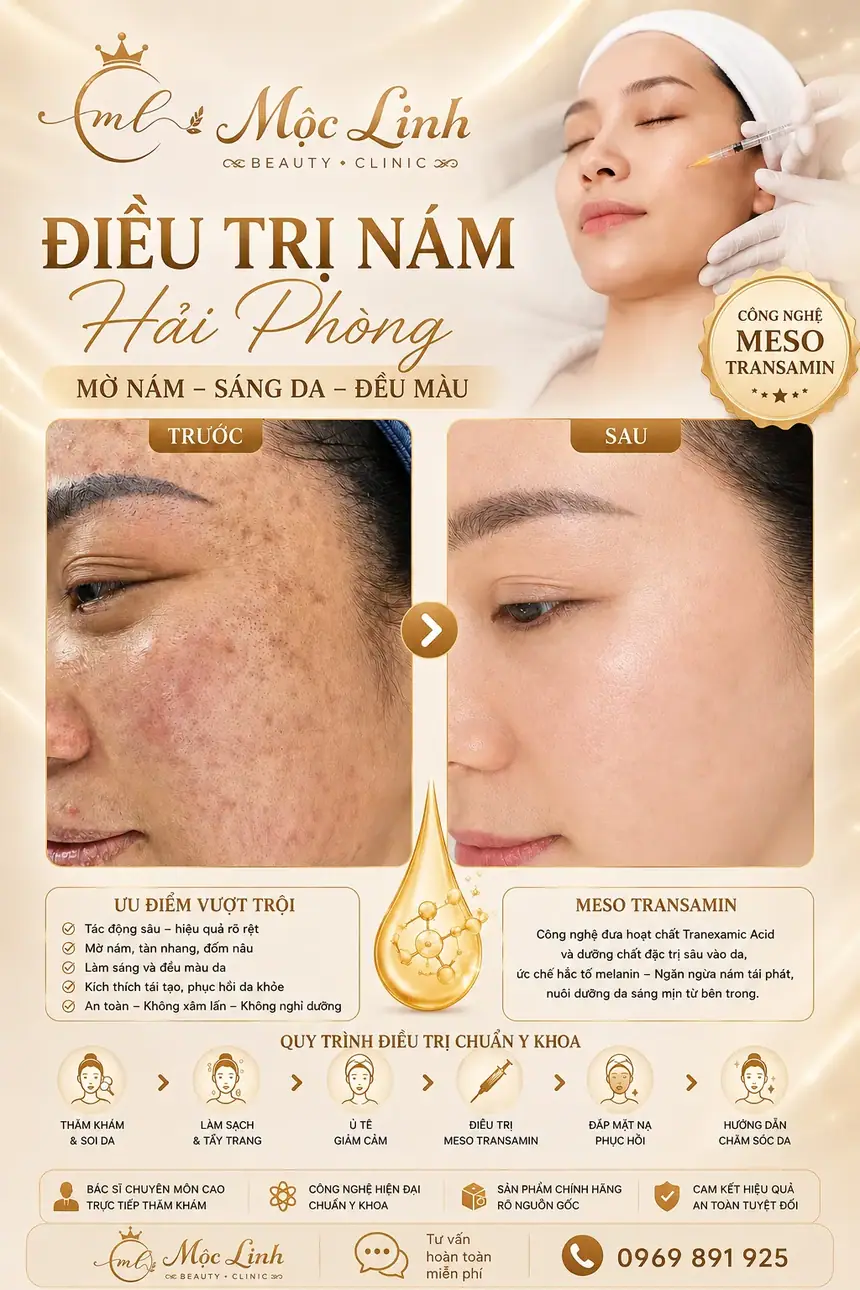 Liệu trình điều trị nám chuẩn y khoa Hải Phòng