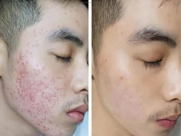 Feedback khách hàng điều trị mụn thành công tại Mộc Linh Hải Phòng