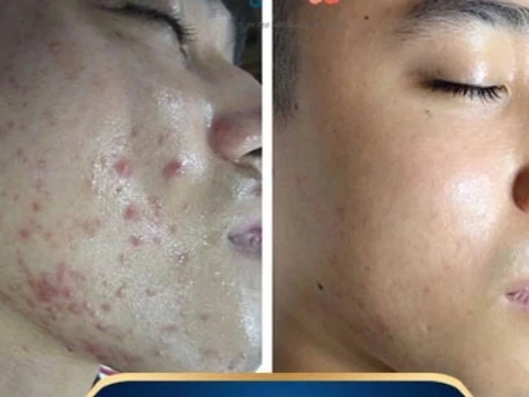 Đánh giá dịch vụ trị mụn của khách hàng tại Mộc Linh Hải Phòng
