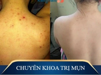 Phản hồi tích cực về liệu trình trị mụn tại Thẩm Mỹ Mộc Linh