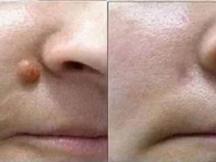 Tẩy nốt ruồi, mụn cơm, mụn thịt tại Thẩm Mỹ Mộc Linh Hải Phòng - hình 11