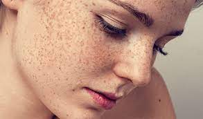 Điều trị tăng sắc tố da tại Thẩm Mỹ Mộc Linh Hải Phòng - hình 2
