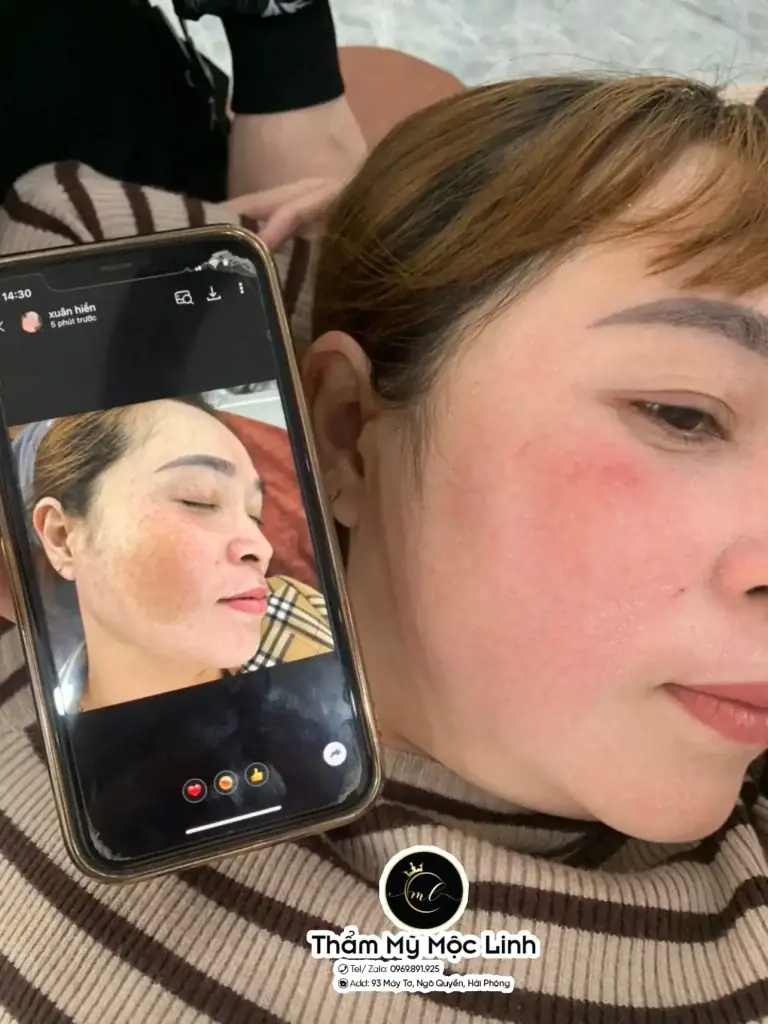 Trị nám/tàn nhang uy tín tại Hải Phòng tại Thẩm Mỹ Mộc Linh - hình 8