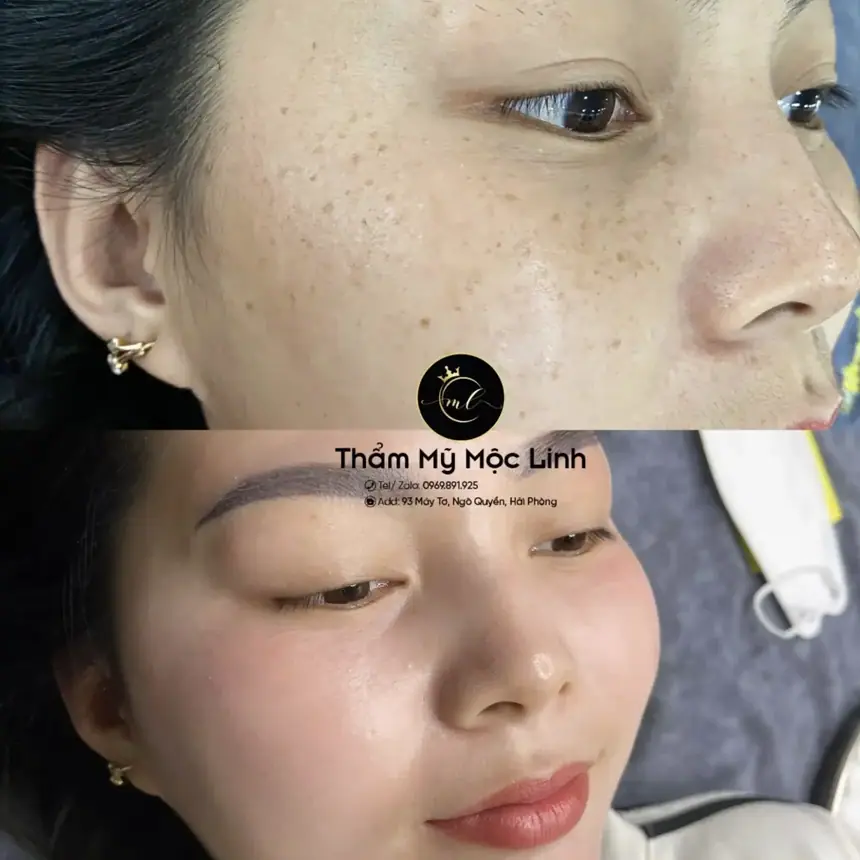Trị nám/tàn nhang uy tín tại Hải Phòng tại Thẩm Mỹ Mộc Linh - hình 7