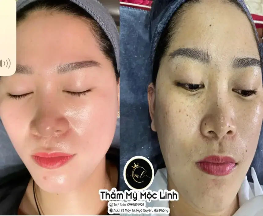 Trị nám/tàn nhang uy tín tại Hải Phòng tại Thẩm Mỹ Mộc Linh - hình 6
