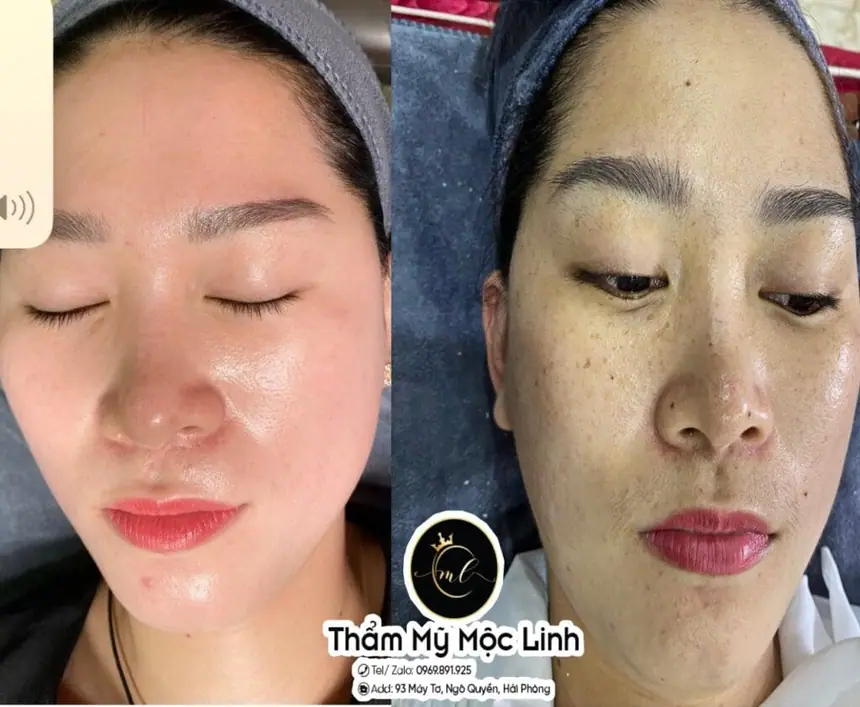 Trị nám/tàn nhang uy tín tại Hải Phòng tại Thẩm Mỹ Mộc Linh - hình 84