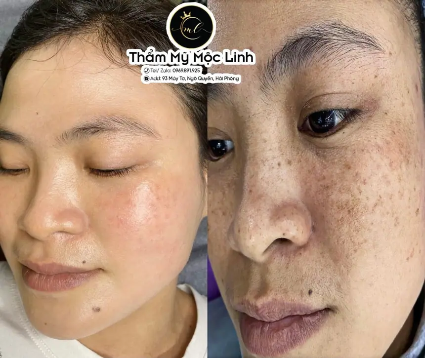 Kết quả điều trị nám da cho khách hàng tại Thẩm Mỹ Mộc Linh Hải Phòng