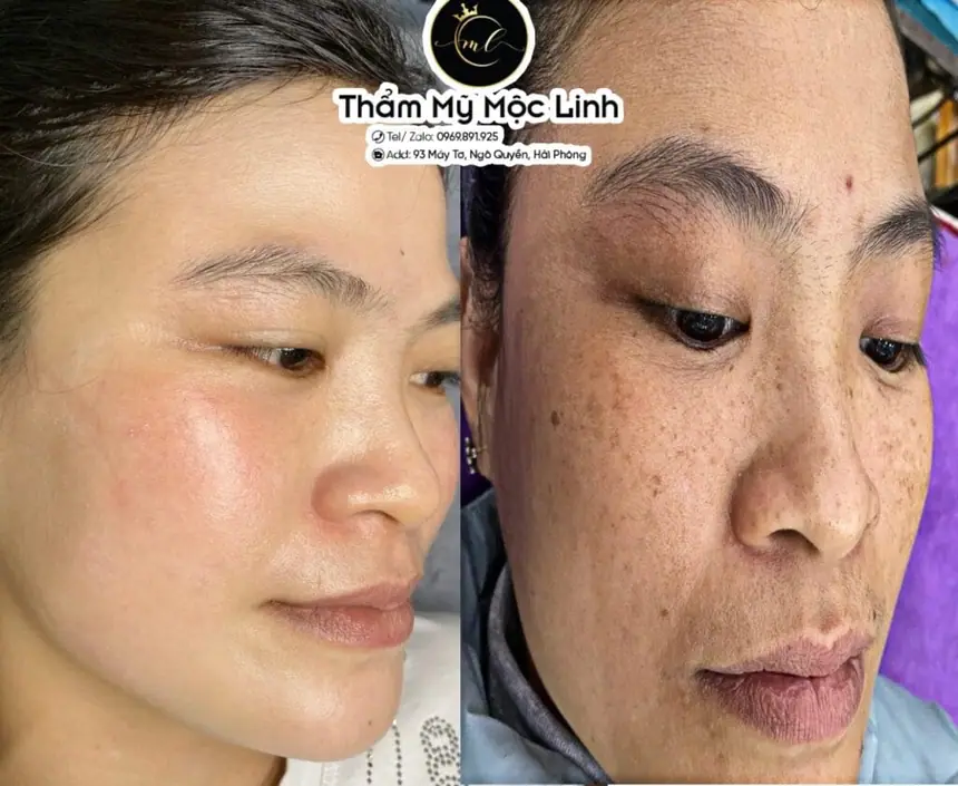 Trị nám/tàn nhang uy tín tại Hải Phòng tại Thẩm Mỹ Mộc Linh - hình 82