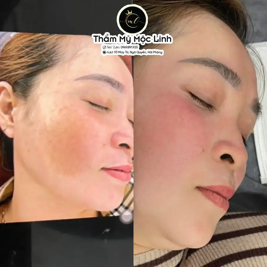 Trị nám/tàn nhang uy tín tại Hải Phòng tại Thẩm Mỹ Mộc Linh - hình 5
