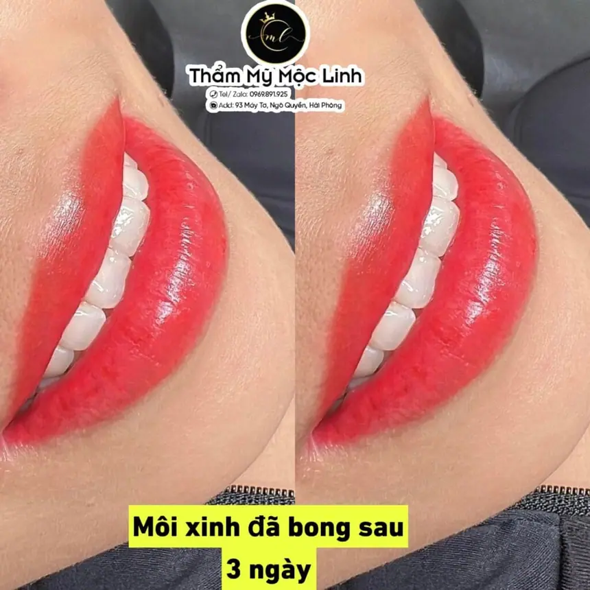 Xăm môi (Phun môi) tại Thẩm Mỹ Mộc Linh Hải Phòng - hình 2