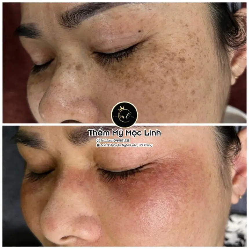 Trị nám/tàn nhang uy tín tại Hải Phòng tại Thẩm Mỹ Mộc Linh - hình 78