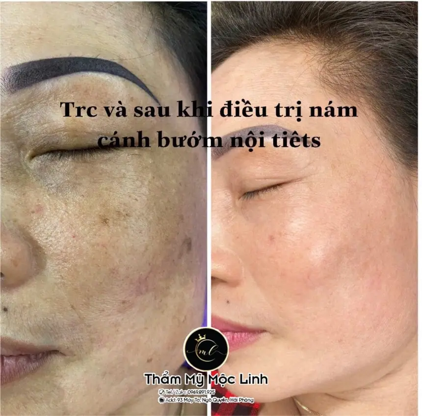 Trị nám/tàn nhang uy tín tại Hải Phòng tại Thẩm Mỹ Mộc Linh - hình 77