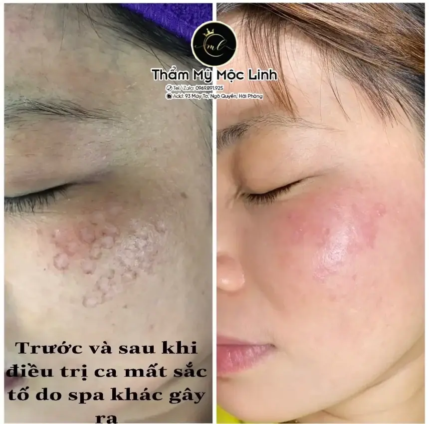 Trị nám/tàn nhang uy tín tại Hải Phòng tại Thẩm Mỹ Mộc Linh - hình 2