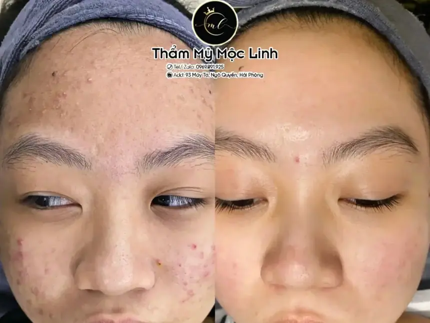 Kết quả điều trị mụn thực tế tại cơ sở Mộc Linh Hải Phòng