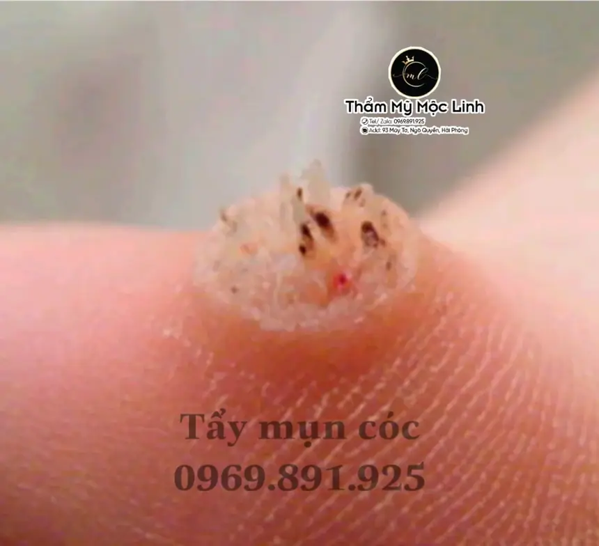 Tẩy nốt ruồi, mụn cơm, mụn thịt tại Thẩm Mỹ Mộc Linh Hải Phòng - hình 8