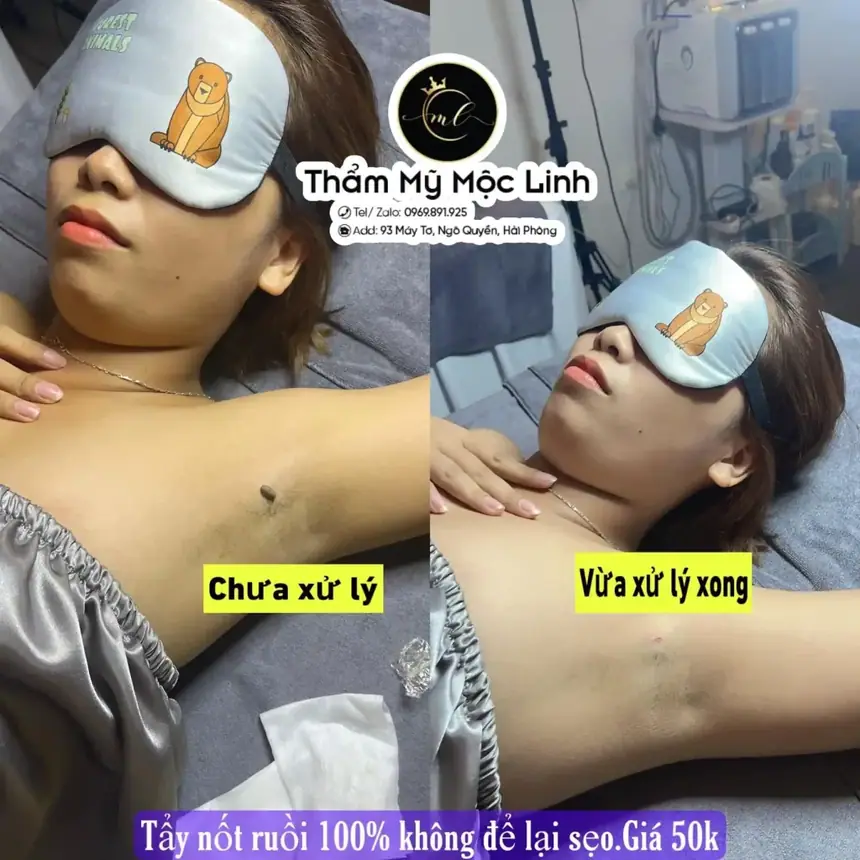 Tẩy nốt ruồi, mụn cơm, mụn thịt tại Thẩm Mỹ Mộc Linh Hải Phòng - hình 7