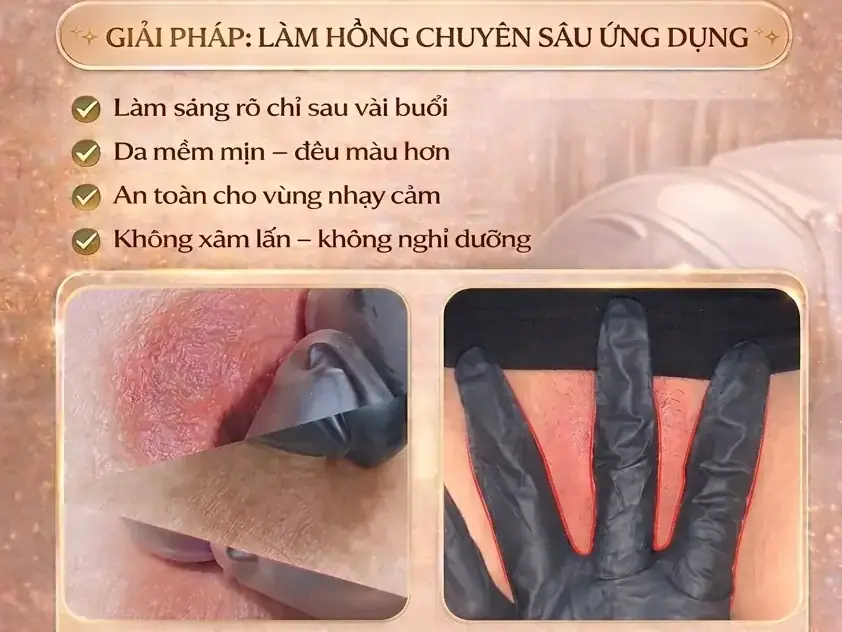 Làm hồng vùng kín bằng laser tại Thẩm Mỹ Mộc Linh Hải Phòng