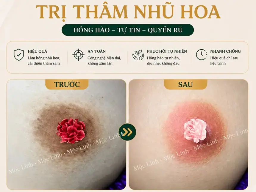 Làm hồng vùng kín bằng laser tại Thẩm Mỹ Mộc Linh Hải Phòng - hình 9