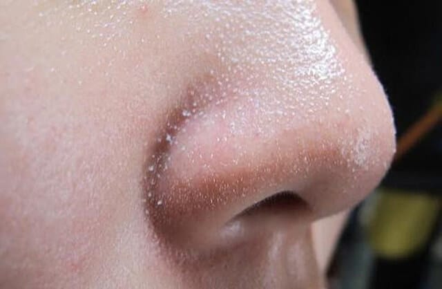 Phân biệt các kiểu mụn thường gặp tại Thẩm Mỹ Mộc Linh Hải Phòng - hình 3