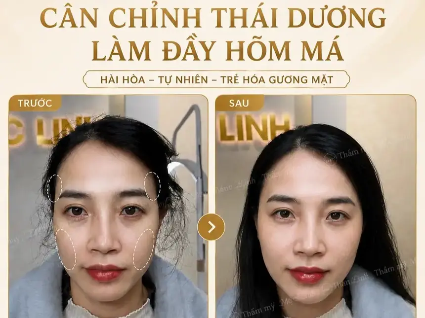 Tiêm Filler An Toàn Uy Tín Hải Phòng tại Thẩm Mỹ Mộc Linh - hình 3