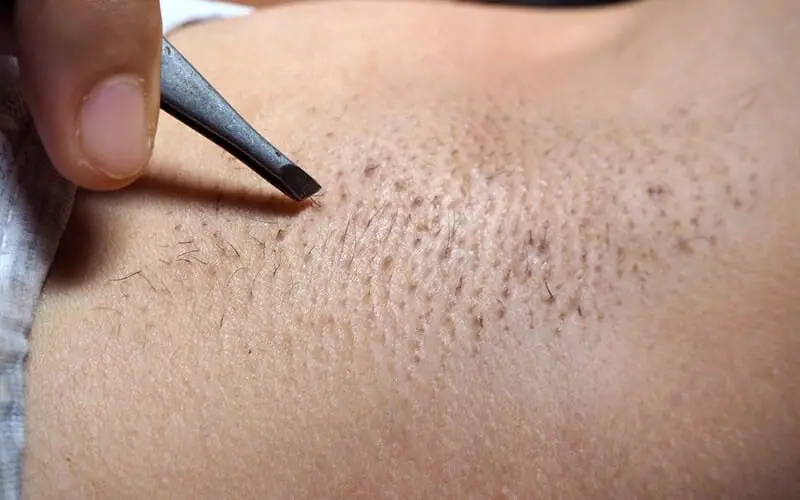 Tận hưởng ngay dịch vụ triệt lông vĩnh viễn bằng công tại Thẩm Mỹ Mộc Linh Hải Phòng - hình 3