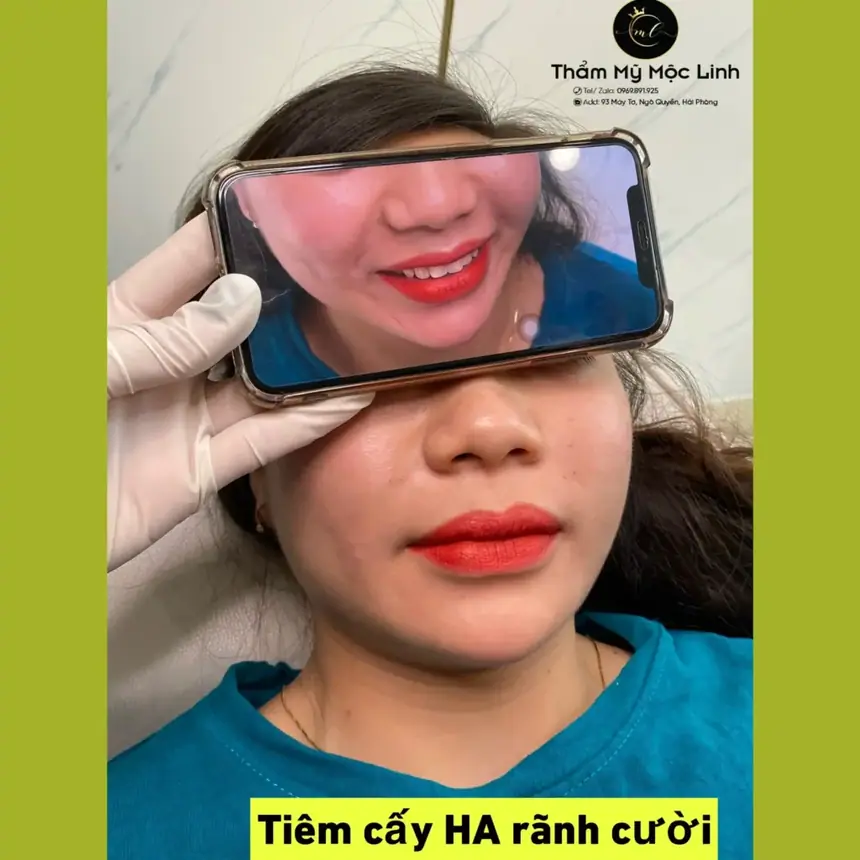 Tiêm Filler An Toàn Uy Tín Hải Phòng tại Thẩm Mỹ Mộc Linh - hình 10
