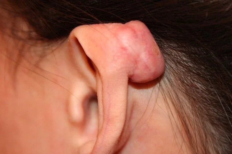 Xử lí sẹo lồi vành tai cam kết chất lượng dịch vụ cho tại Thẩm Mỹ Mộc Linh Hải Phòng - hình 2