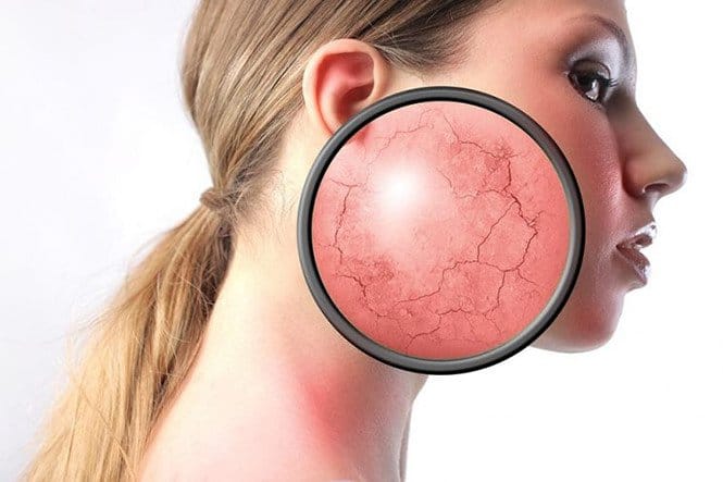 5 lý do khiến da bị mụn và cách chữa trị tại Thẩm Mỹ Mộc Linh Hải Phòng - hình 3