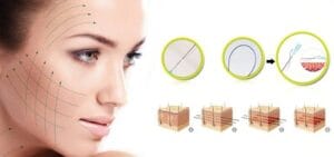 Căng Chỉ Collagen – Giải pháp trẻ hoá da của phái đẹp