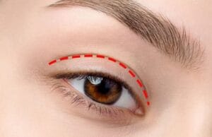 Liệu nhấn mí có đang là xu hướng làm đẹp của chị em tại Thẩm Mỹ Mộc Linh Hải Phòng - hình 1