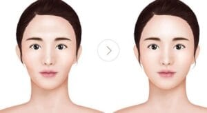 Nâng và hạ gò má tại Thẩm Mỹ Mộc Linh Hải Phòng - hình 3