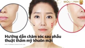 Hướng dẫn chăm sóc sau phẫu thuật thẩm mỹ khuôn mặt tại Thẩm Mỹ Mộc Linh Hải Phòng - hình 1