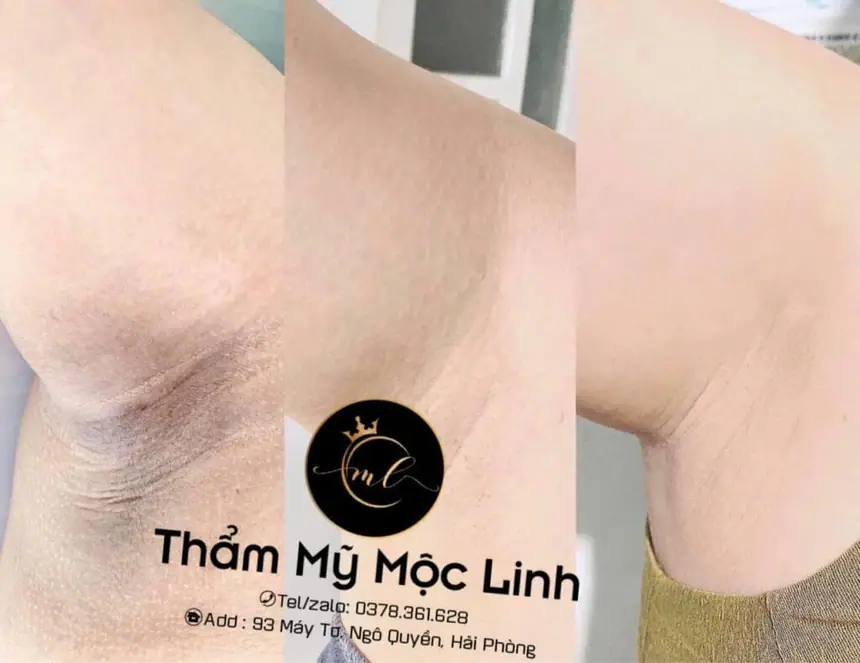 Cách Trị Thâm Nách Đơn Giản, Hiệu Quả Và Nhanh Chóng tại Thẩm Mỹ Mộc Linh Hải Phòng - hình 2