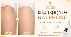Chữa rạn da tại Thẩm Mỹ Mộc Linh Hải Phòng - hình 6