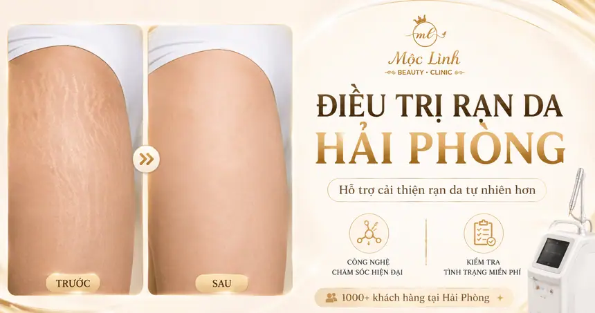 Điều Trị Rạn Da