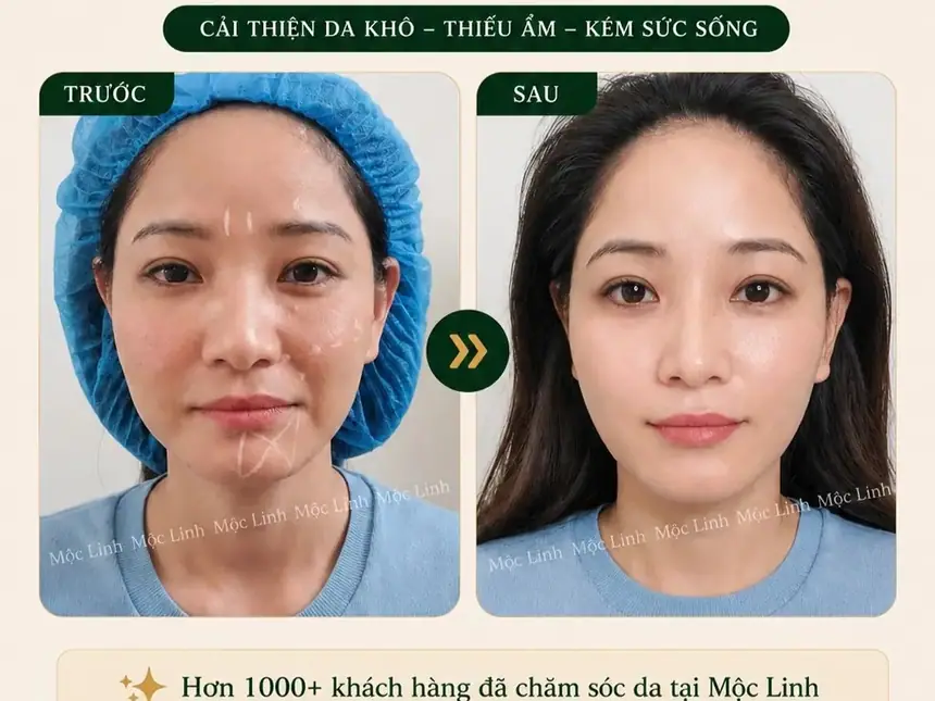 Tiêm BAP tại Thẩm Mỹ Mộc Linh Hải Phòng - hình 8