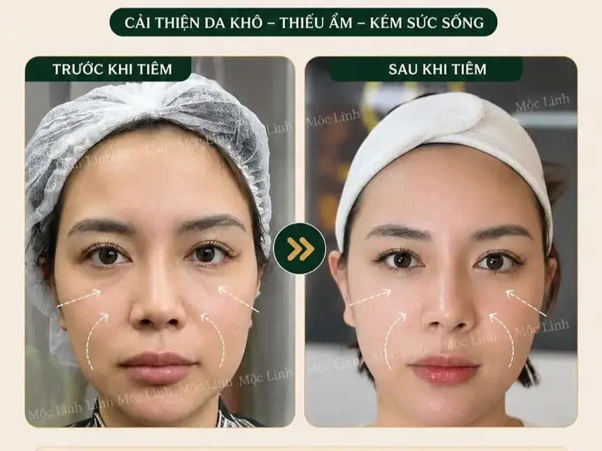 Tiêm BAP tại Thẩm Mỹ Mộc Linh Hải Phòng - hình 7