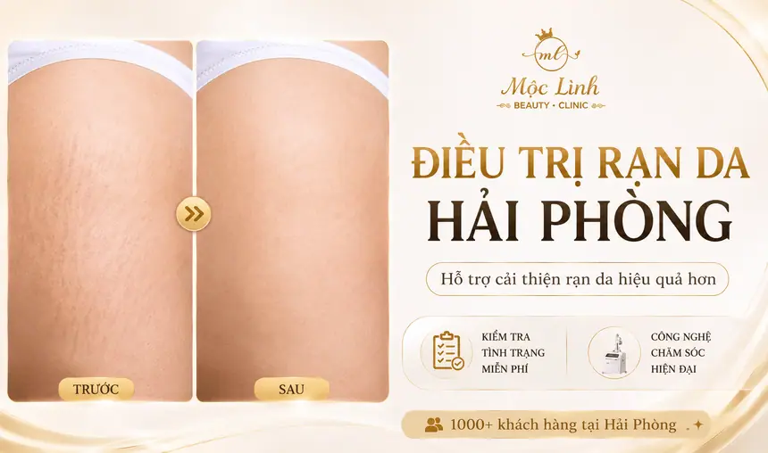 Chữa rạn da tại Thẩm Mỹ Mộc Linh Hải Phòng