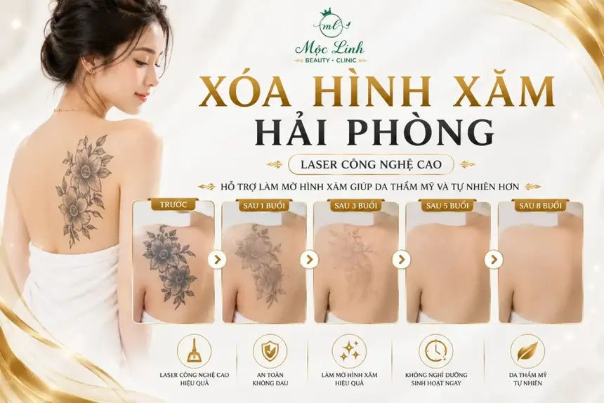 Xoá hình xăm Hải Phòng tại Thẩm Mỹ Mộc Linh - hình 17