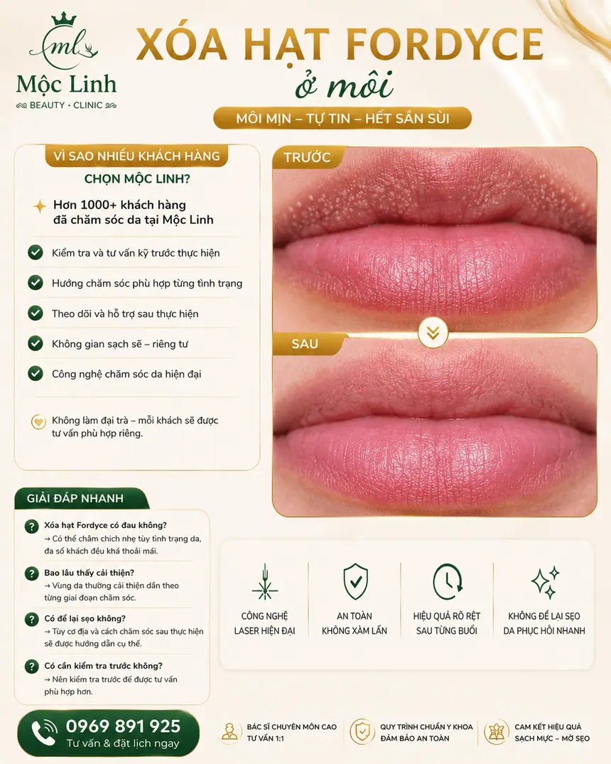 Xoá hạt Fordyce Hải Phòng tại Thẩm Mỹ Mộc Linh - hình 7