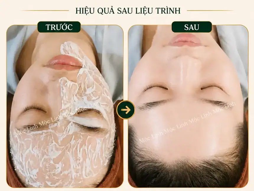 Cấy trắng da tại Thẩm Mỹ Mộc Linh Hải Phòng - hình 2