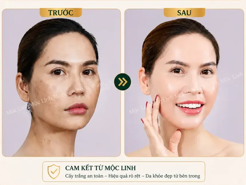 Cấy trắng da tại Thẩm Mỹ Mộc Linh Hải Phòng